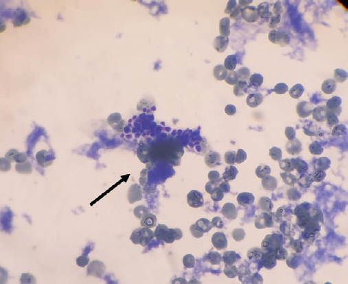 Giemsa (×20) stained peripheral blood smear showing small budding yeast cells.